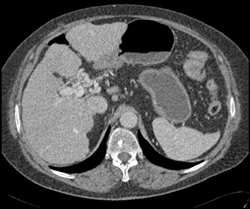 Cavernous Transformation of the Portal Vein - CTisus CT Scan