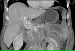 Cavernous Transformation of the Portal Vein - CTisus CT Scan