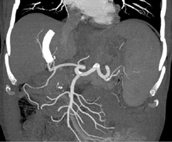 Transjugular Intrahepatic Portosystemic Shunt (TIPS) in Cirrhotic Patient - CTisus CT Scan