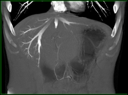 Reflux of Contrast Into the IVC and Hepatic Veins - CTisus CT Scan