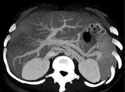 Cirrhosis - CTisus CT Scan