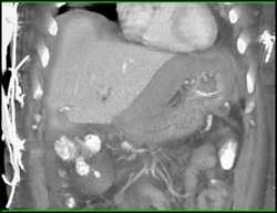 Perihepatic Bleed - CTisus CT Scan