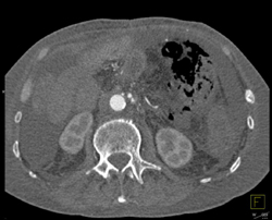 Cirrhosis - CTisus CT Scan