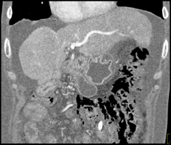 Cirrhosis - CTisus CT Scan