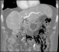 Cirrhosis - CTisus CT Scan