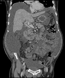 Cirrhosis With Clot in Portal Vein - CTisus CT Scan