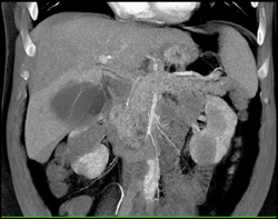 Acute Cholecystitis - CTisus CT Scan