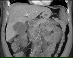 Acute Cholecystitis - CTisus CT Scan