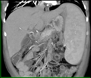 Cirrhosis With Splenomegaly - CTisus CT Scan