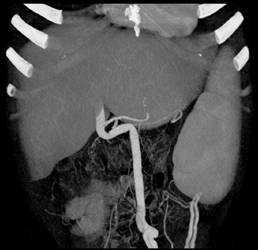 Cirrhosis With Portal Hypertension With Dilated Umbilical Vein - CTisus CT Scan