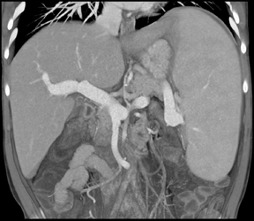 Cirrhosis - CTisus CT Scan