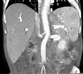 Cirrhosis - CTisus CT Scan