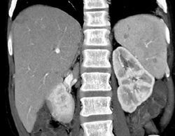 Cirrhosis With Splenic Cysts - CTisus CT Scan