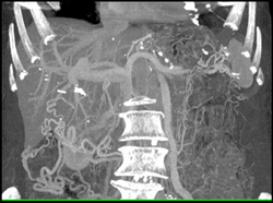 Collaterals With Portal Hypertension - CTisus CT Scan