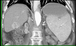 Hepatoma - CTisus CT Scan