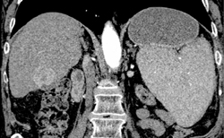 Hepatoma - CTisus CT Scan