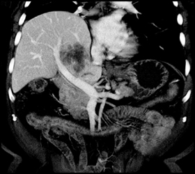 Hepatoma - CTisus CT Scan