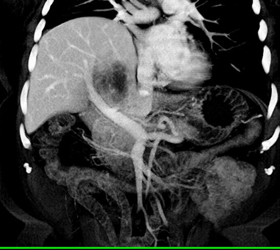 Hepatoma - CTisus CT Scan