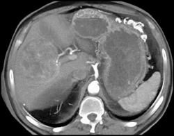 Hepatoma - CTisus CT Scan