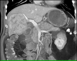 Hepatoma - CTisus CT Scan