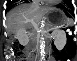 Hepatoma - CTisus CT Scan