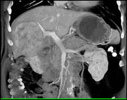 Hepatoma - CTisus CT Scan