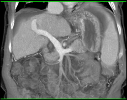 Cirrhosis and Gastric Varices - CTisus CT Scan