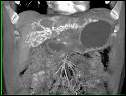 Unusual Hemangioma - CTisus CT Scan