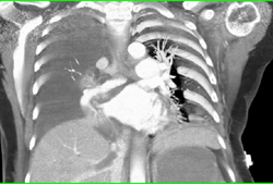 Clot in Hepatic Veins and IVC - CTisus CT Scan