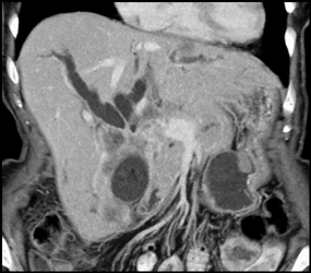 Cholangiocarcinoma - CTisus CT Scan