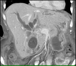 Cholangiocarcinoma - CTisus CT Scan