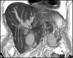 Cholangiocarcinoma - CTisus CT Scan