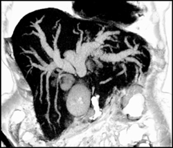 Cholangiocarcinoma - CTisus CT Scan