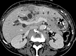 Cholangiocarcinoma - CTisus CT Scan