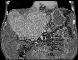 Cirrhosis - CTisus CT Scan