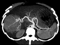 Focal Nodular Hyperplasia - CTisus CT Scan