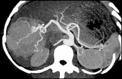 Focal Nodular Hyperplasia - CTisus CT Scan