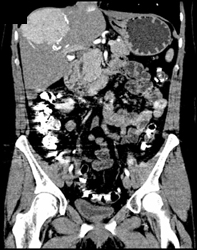 Focal Nodular Hyperplasia - CTisus CT Scan