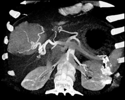 Focal Nodular Hyperplasia - CTisus CT Scan