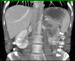 Focal Nodular Hyperplasia - CTisus CT Scan