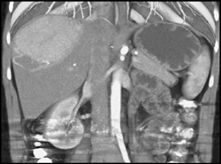 Focal Nodular Hyperplasia - CTisus CT Scan