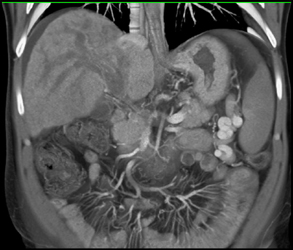 Cholangiocarcinoma With Portal Hypertension - CTisus CT Scan