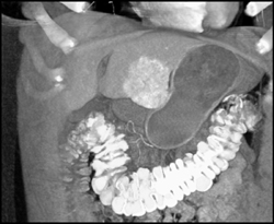 Focal Nodular Hyperplasia (FNH) - CTisus CT Scan