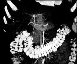 Focal Nodular Hyperplasia (FNH) - CTisus CT Scan