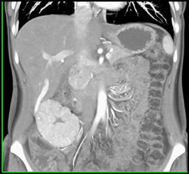 Focal Nodular Hyperplasia (FNH) - CTisus CT Scan