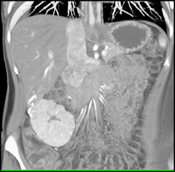 Focal Nodular Hyperplasia (FNH) - CTisus CT Scan