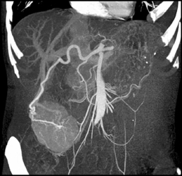 Focal Nodular Hyperplasia (FNH) - CTisus CT Scan