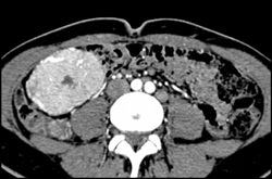 Focal Nodular Hyperplasia (FNH) - CTisus CT Scan