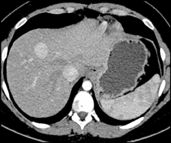 Focal Nodular Hyperplasia (FNH) - CTisus CT Scan