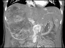 Hepatoma - CTisus CT Scan